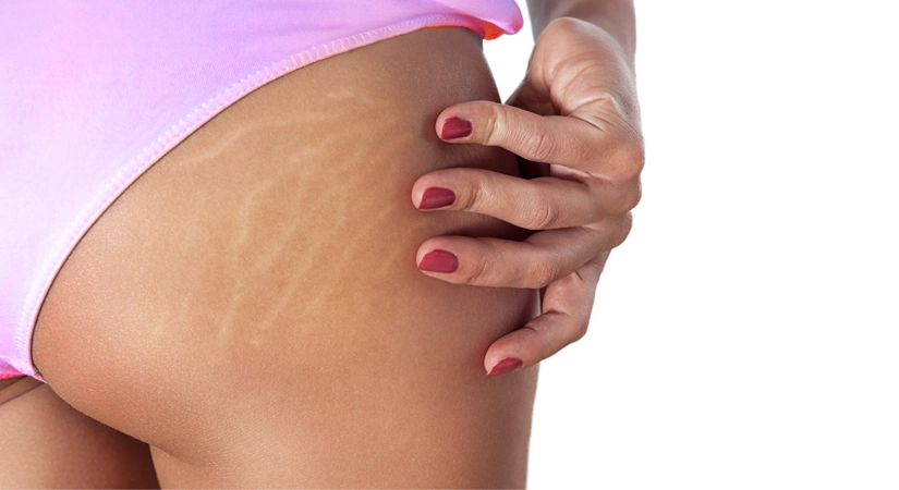 Ciltte Oluşan Çatlaklar Nasıl Engellenir? En Etkili Yöntemler ve Öneriler